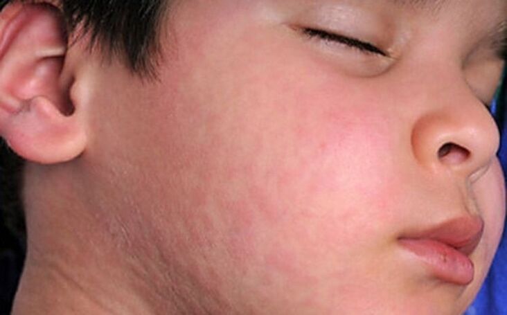 Deride alerjik döküntüler - vücutta parazitik solucanların varlığının bir belirtisi